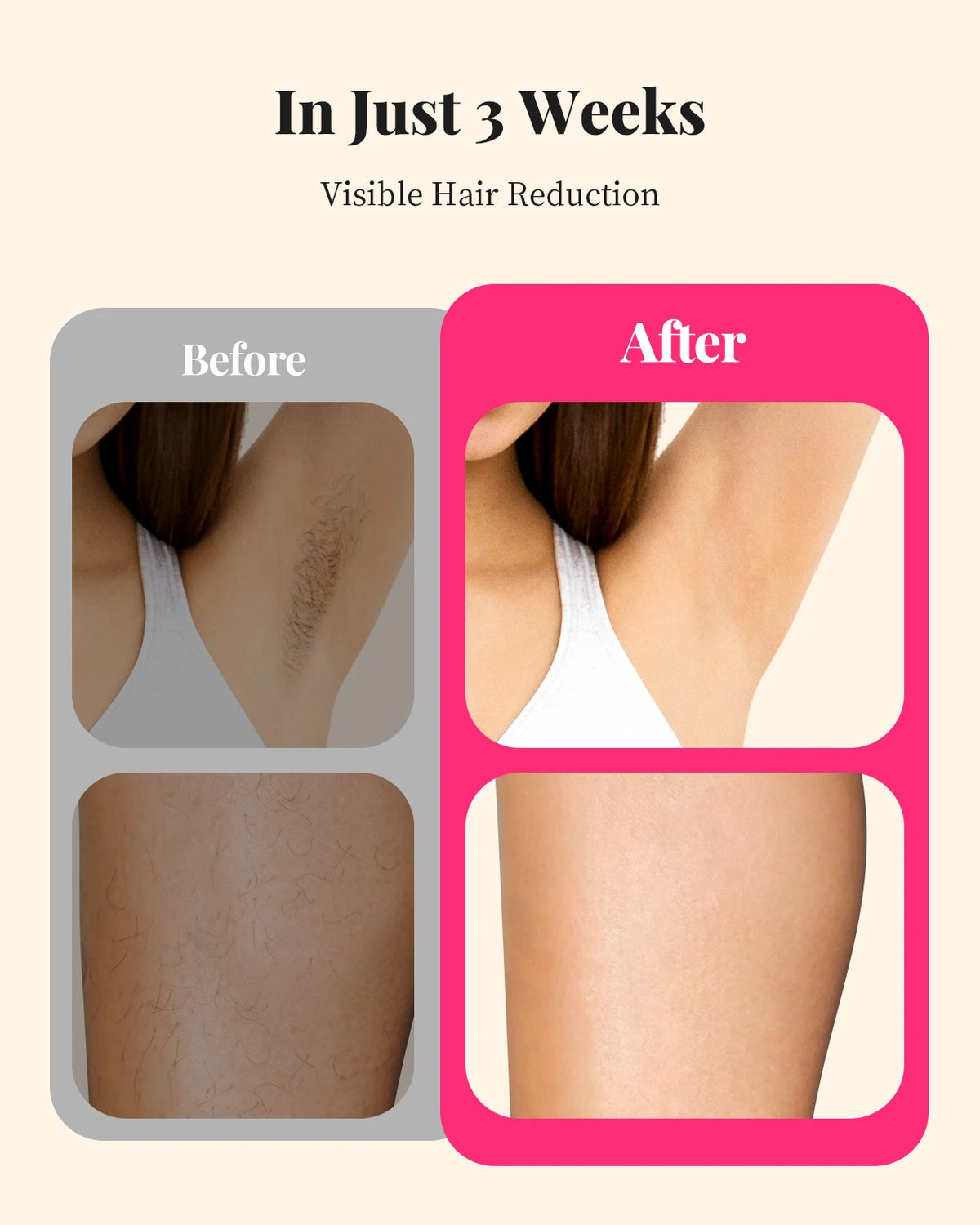 Hair Removal for Women and Men